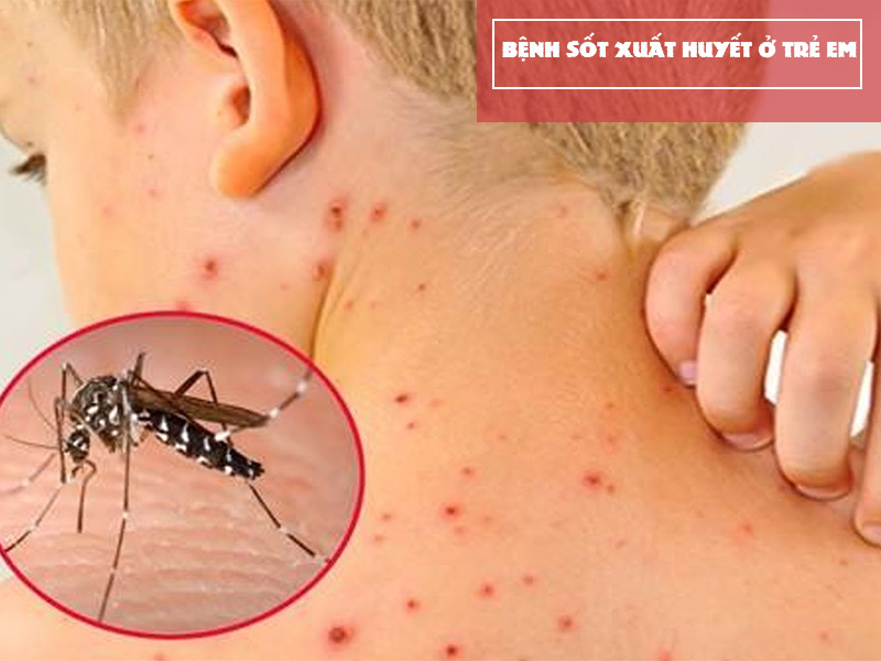 Bệnh sốt xuất huyết do muỗi gây ra ở trẻ em